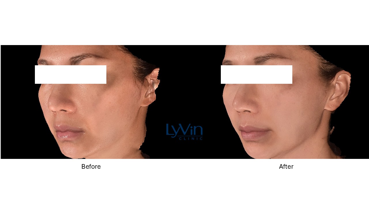Emface + Exion Face Before and After Photo